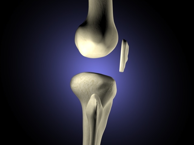 knee replacement 3d model - Knee Replacement 3D MoDel DHQ