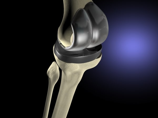 knee replacement 3d model