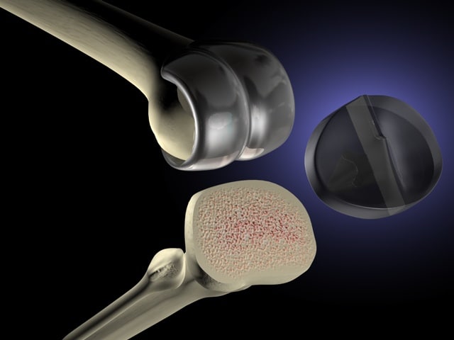 knee replacement 3d model