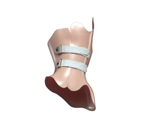 3D scoliosis corset model