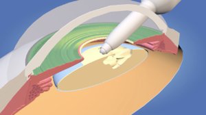 eye cataract surgery lens model