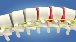 3D spine compression nerve model