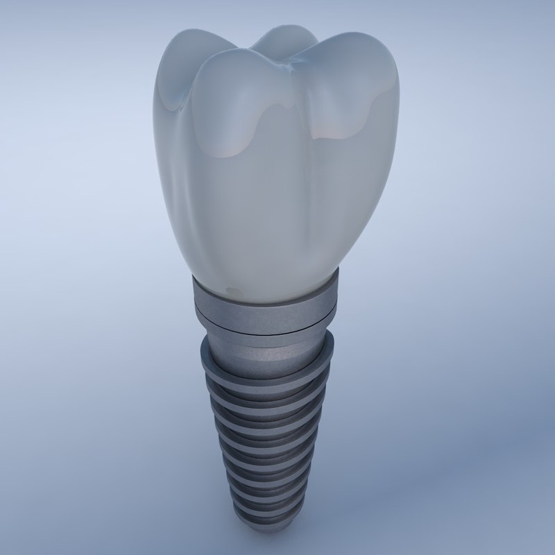 Dental implant 3D model TurboSquid 1213056