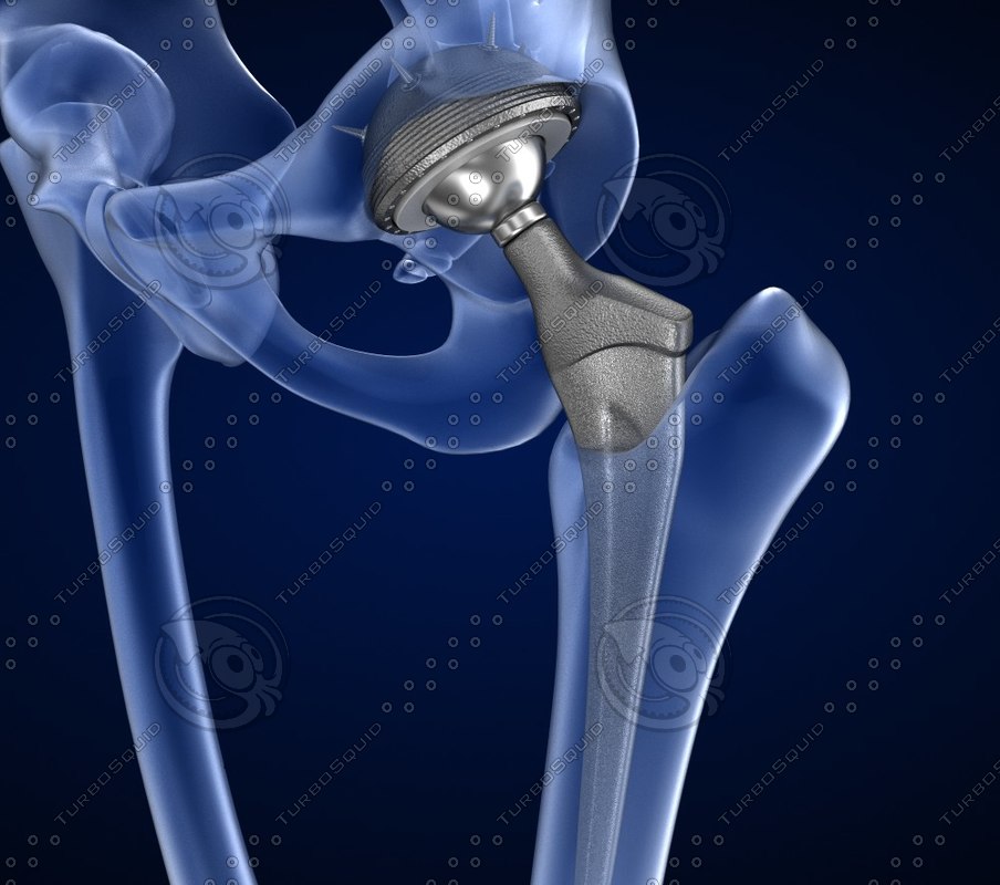 3D hip replacement implant installed model - TurboSquid 1220758