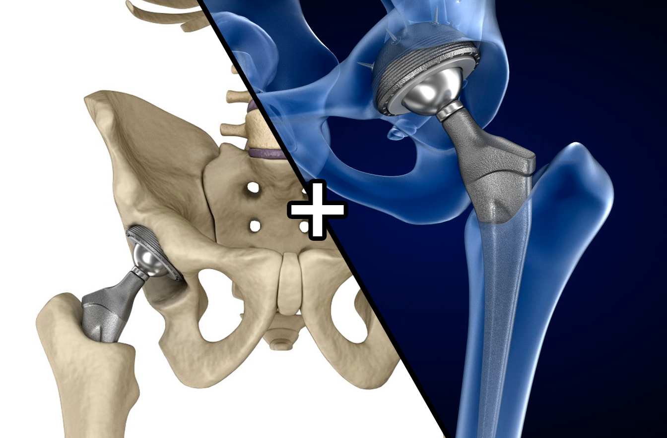 3d Hip Replacement Implant Installed Model - Turbosquid 1220758