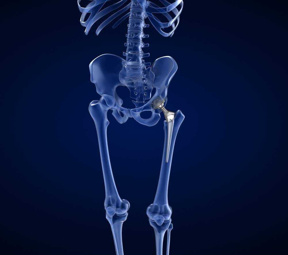 Hip Replacement. Cross Bones 3d models.