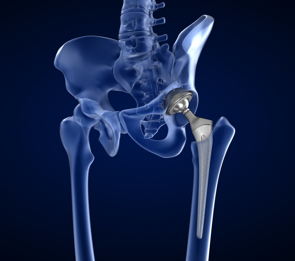 3D hip replacement implant installed model TurboSquid