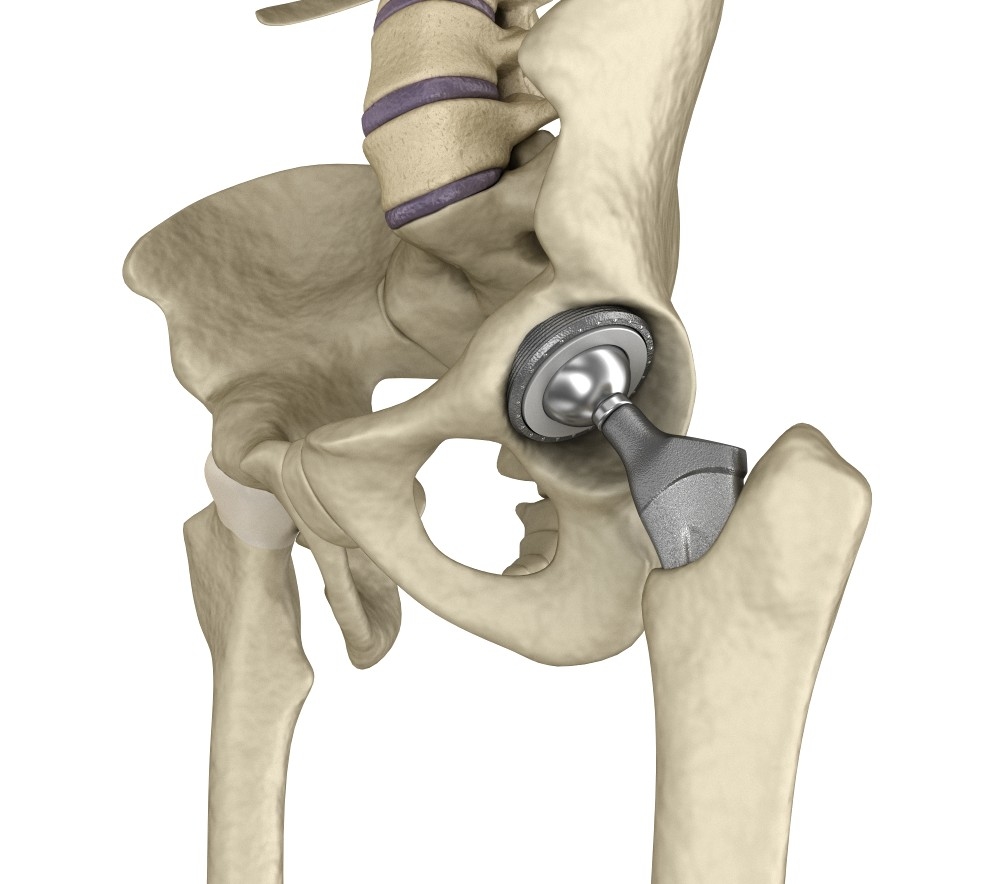 3D hip replacement implant installed model - TurboSquid 1220758