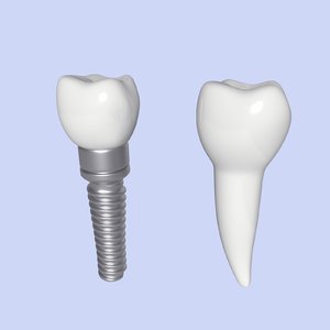 tooth implant 3D model