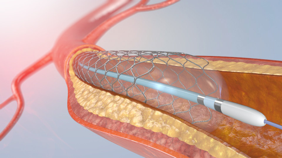 3D model blood stent - TurboSquid 1312675