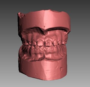 denture human 3D