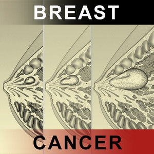 3d model breast cancer laps