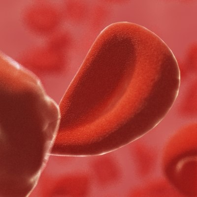 sss sickle-cell anemia