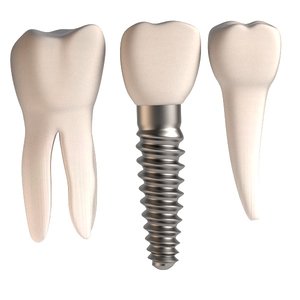 dental implant teeth 3d model