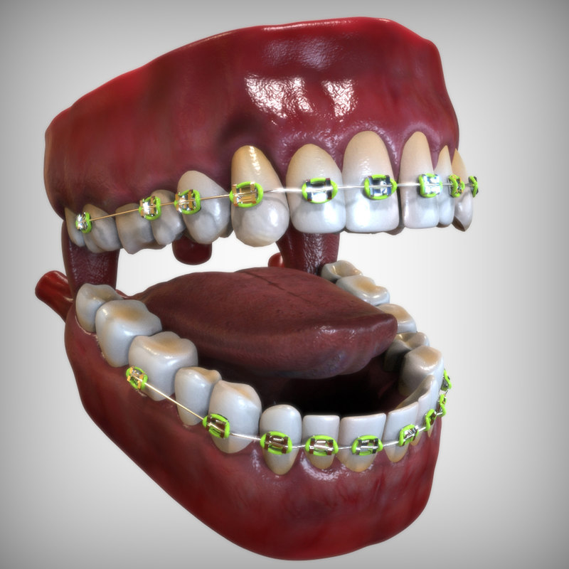 3d mouth dental braces model