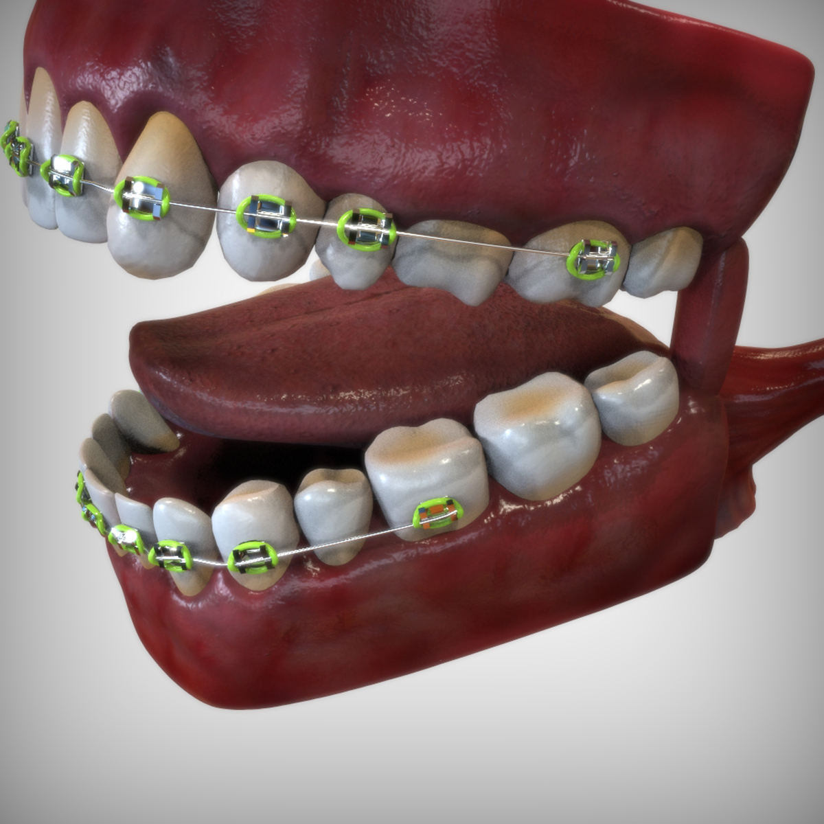 3d mouth dental braces model