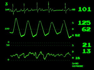 ECG screen