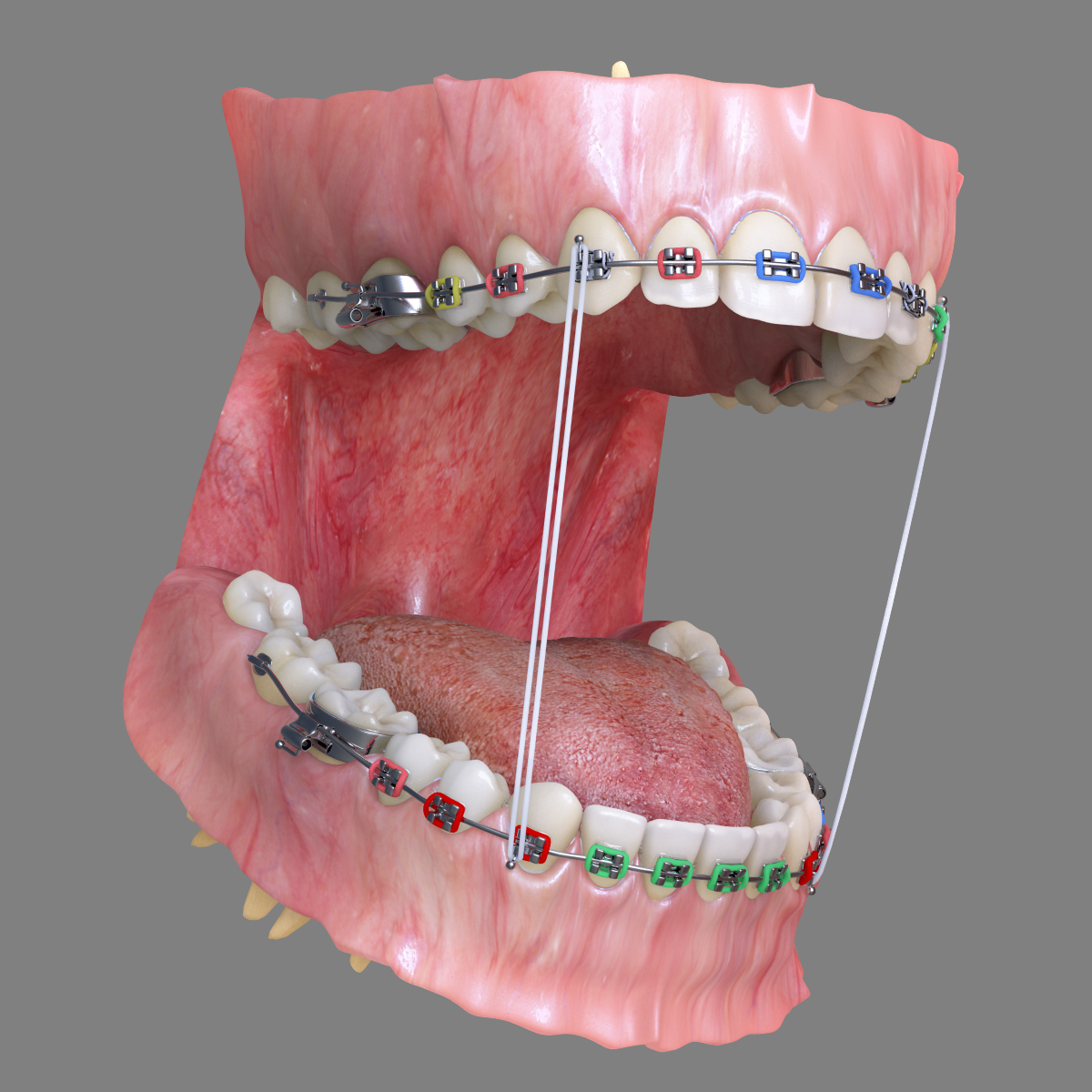 realistic dentition braces 3d max