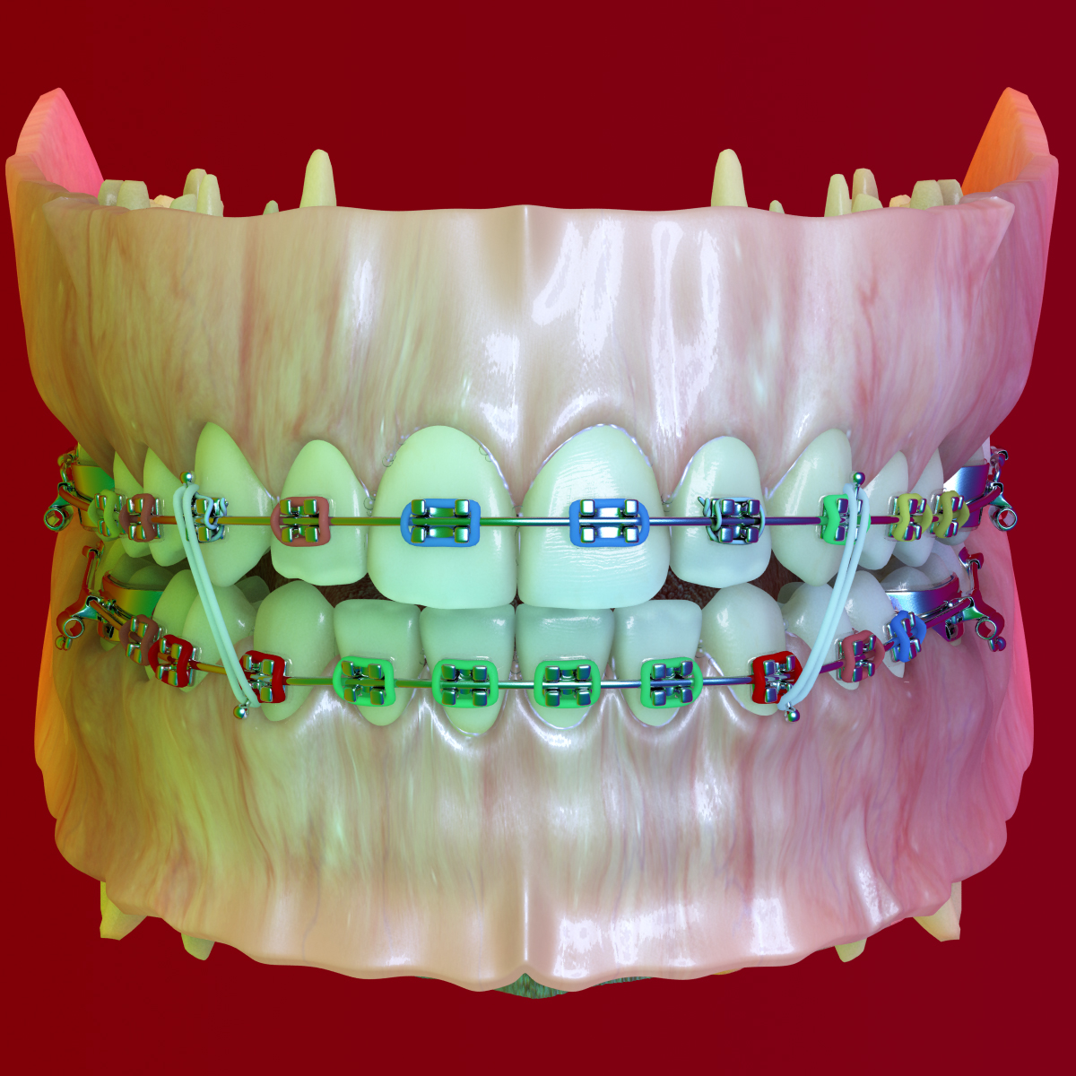 realistic dentition braces 3d max