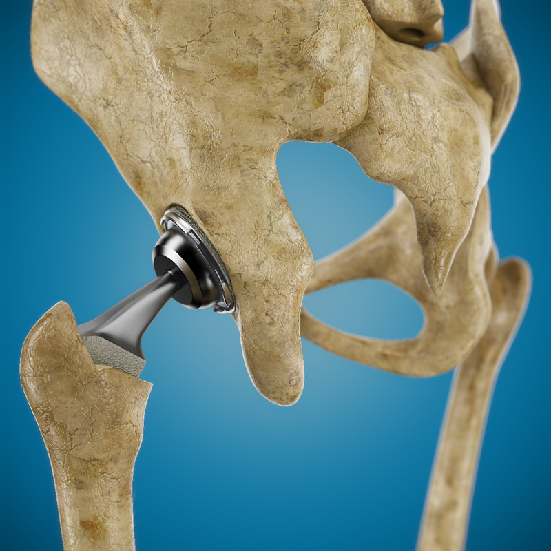 3ds femoral prosthesis tibia pelvis