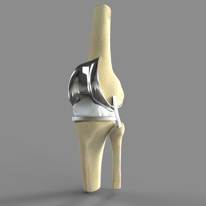 maya knee replacement