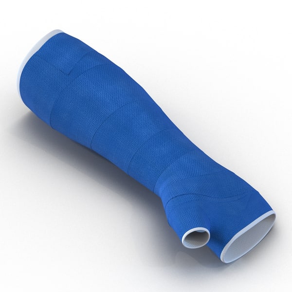 3d blue fiberglass cast arm