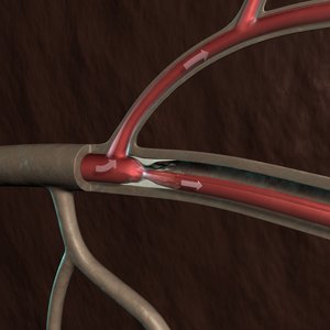 3d model blood clogged artery