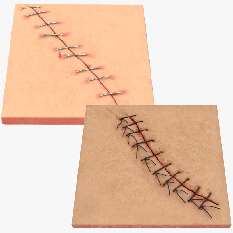 3d staples sutures