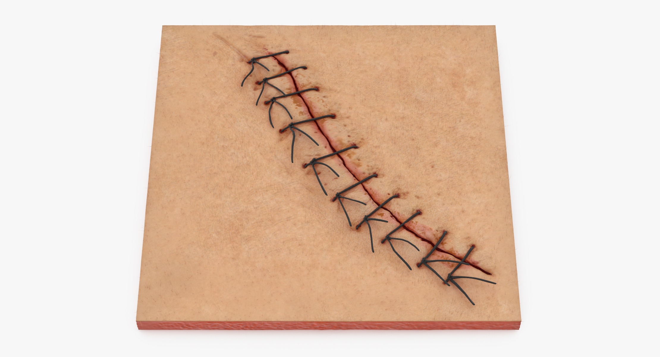 3d-staples-sutures