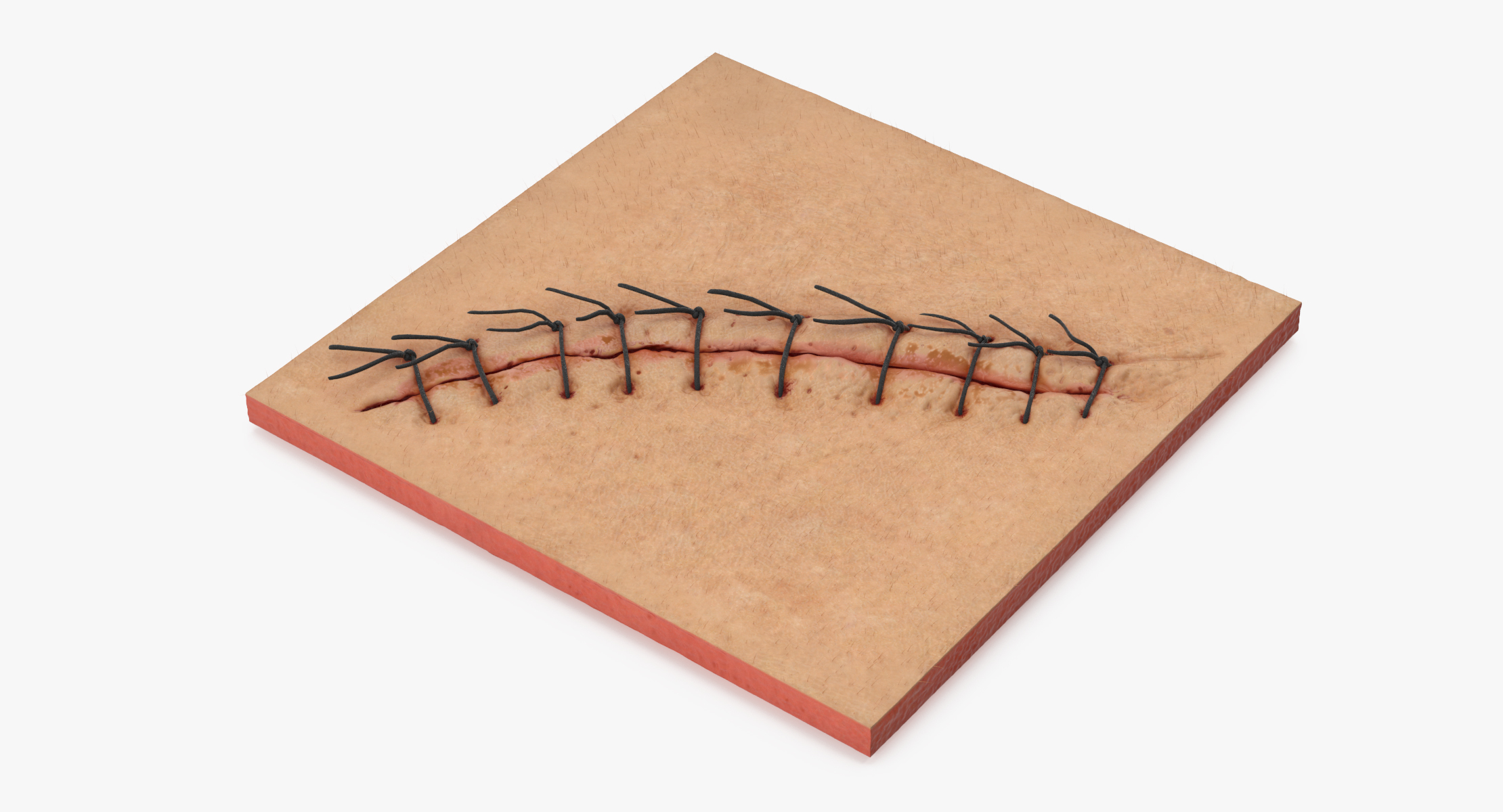 3d-staples-sutures