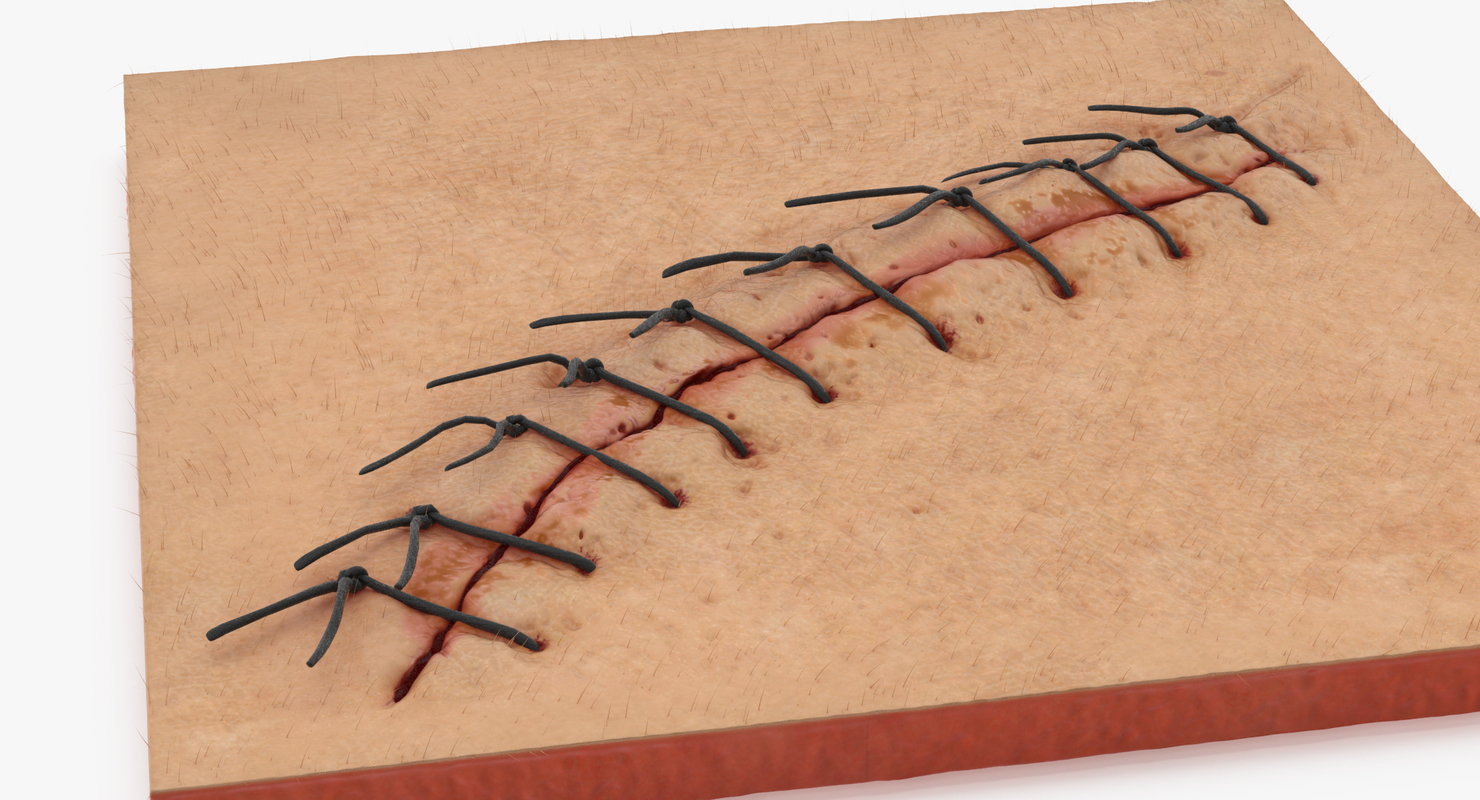 3d Staples Sutures