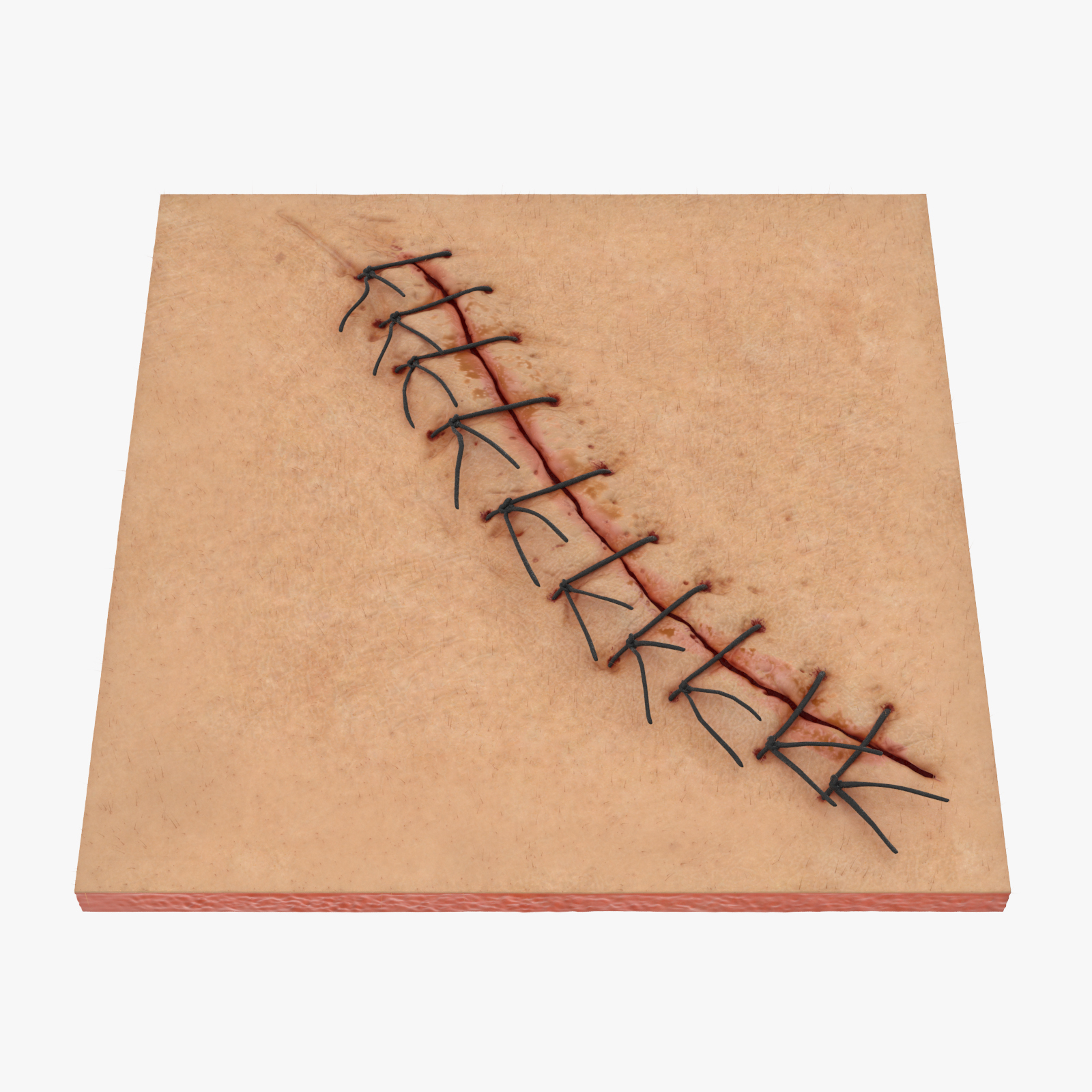 3d staples sutures