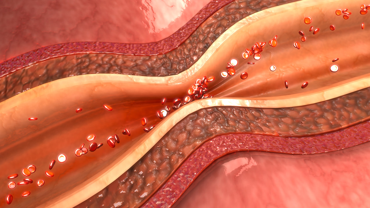 Coronary Arteries 3d Printing Pelajaran