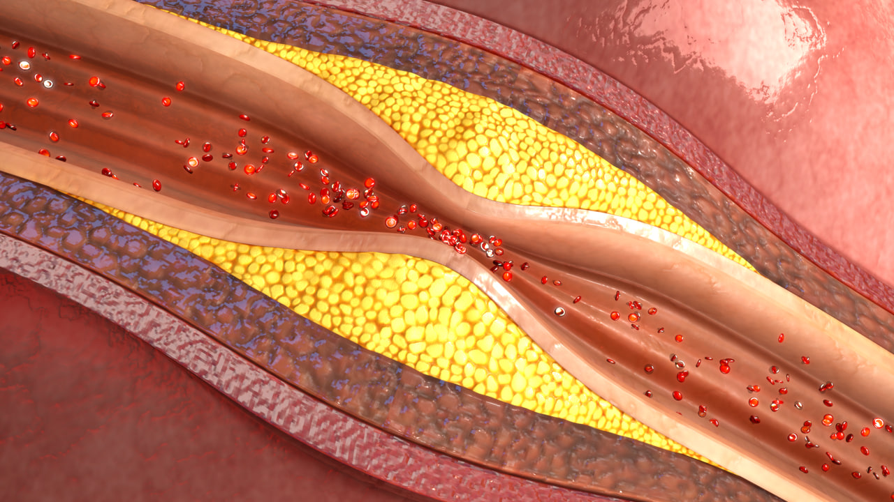 atherosclerosis 3d model