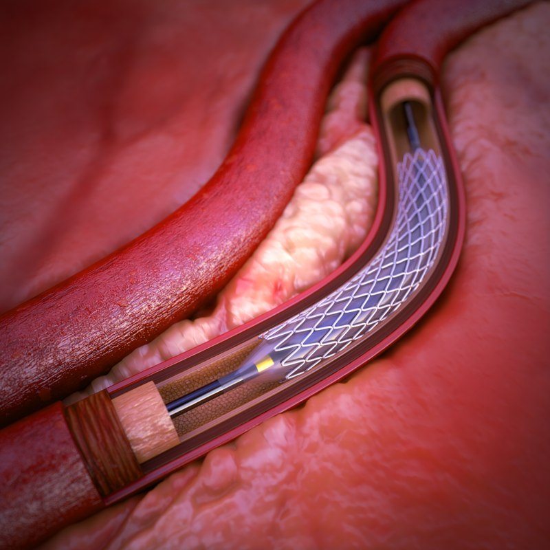 coronary-artery-stent-3d-max