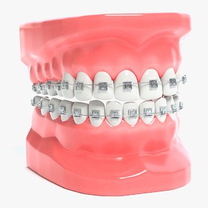 3D mouth braces modeled model