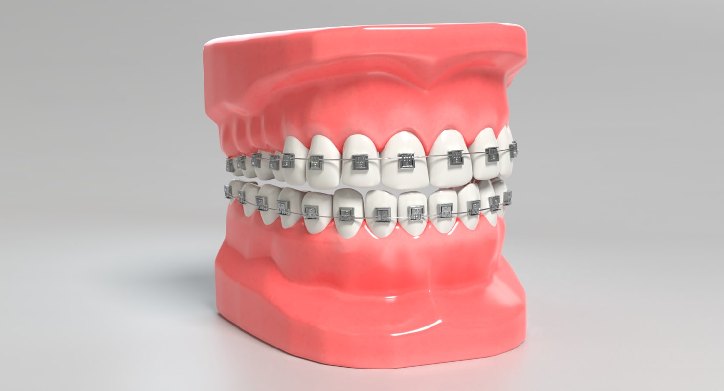3D mouth braces modeled model TurboSquid 1250915