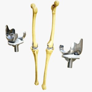 knee endoprosthesis 3D model