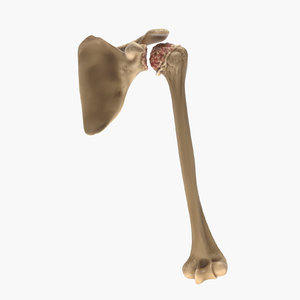 shoulder arthritis 3D model