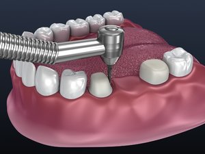 dental tooth supported fixed 3D model