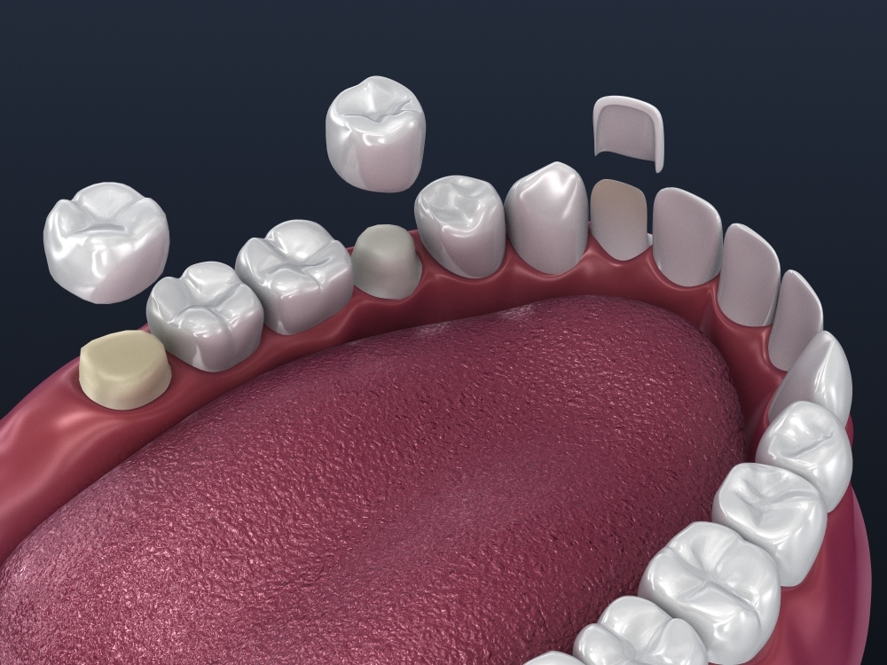 牙科贴面准备和安装3d模型