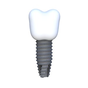 3D tooth implant model