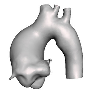 3D ascending aortic aneurysm artery