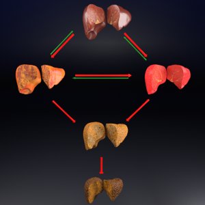 3D alcoholic liver disease fatty model