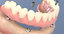 3D denture dental implants