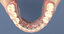 3D denture dental implants