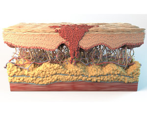 3D skin cancer cells