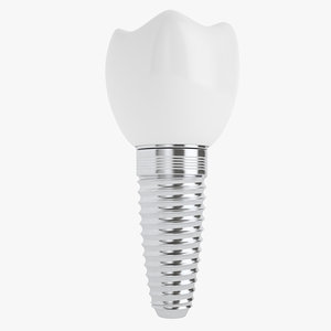 implant teeth 3D