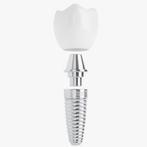 3D model implant teeth