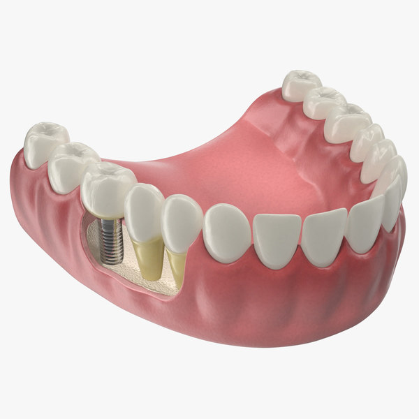 LowerTeethMedicalModelWithDentalImplantc